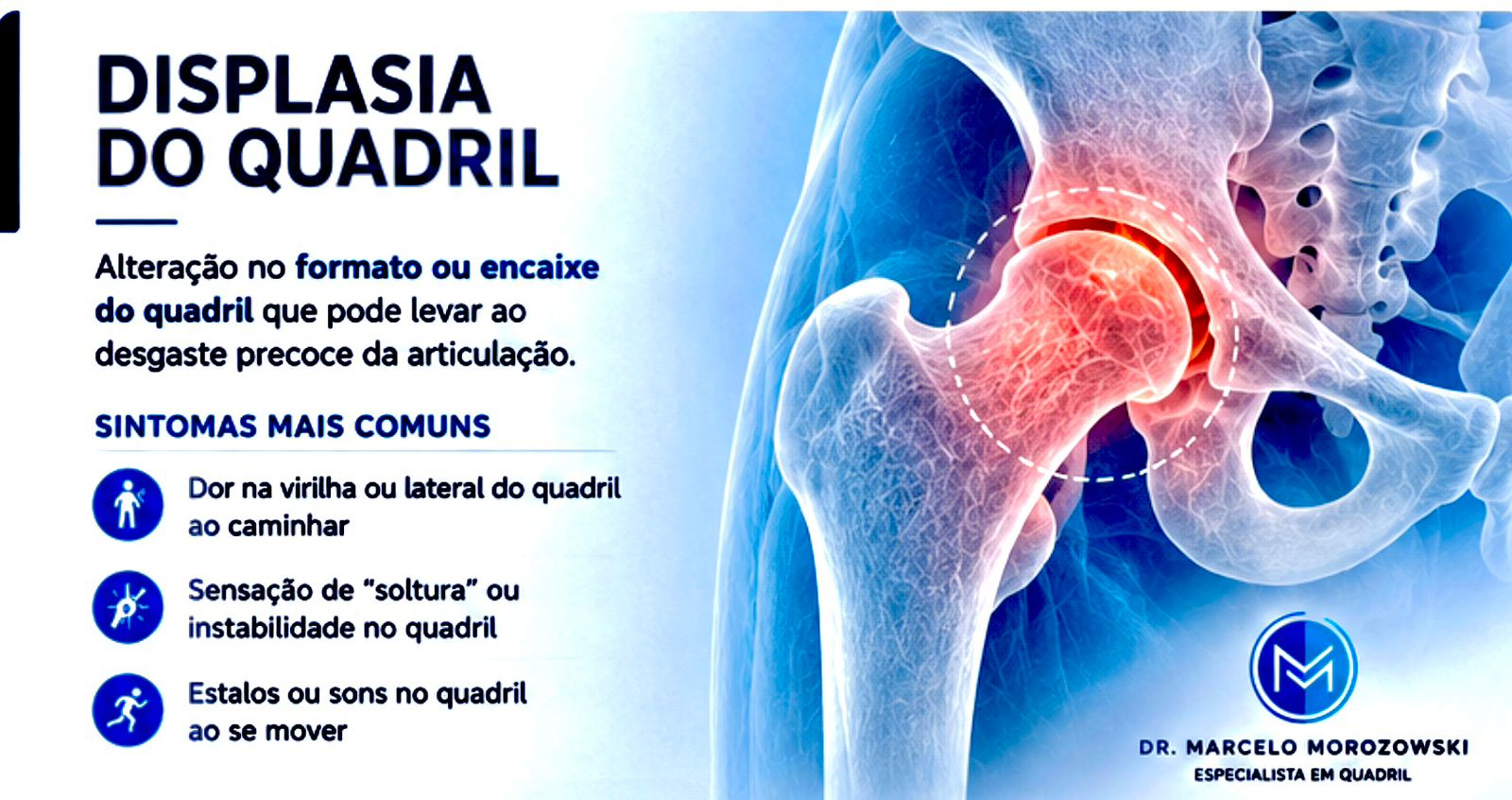 displasia do quadril